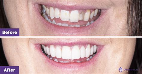 Porcelain Veneers Melbourne .